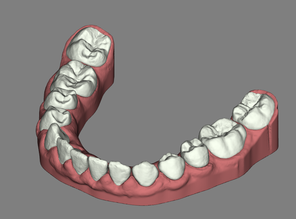 Modelled IOS with closed emergence profile with closed crowns